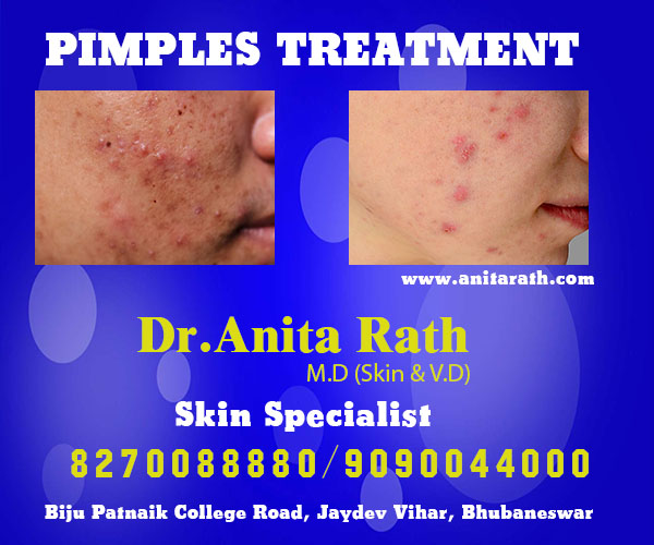 Best pimples treatment clinic in bhubaneswar near capital hospital